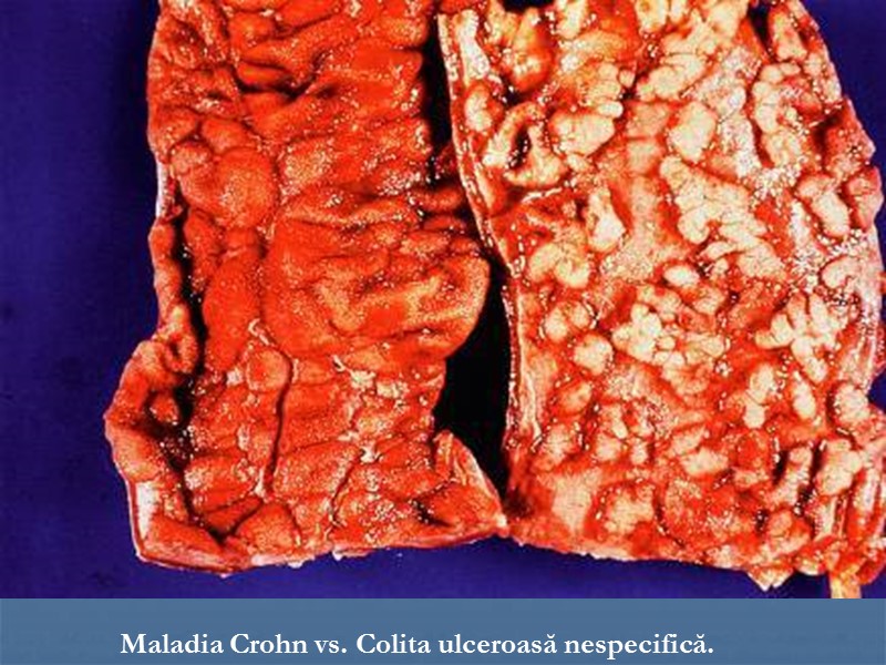 Maladia Crohn vs. Colita ulceroasă nespecifică.
